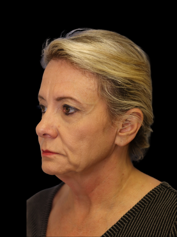 Deep Plane Facelift Gallery Before & After