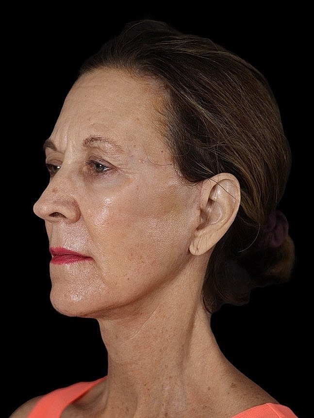 Deep Plane Facelift Gallery Before & After
