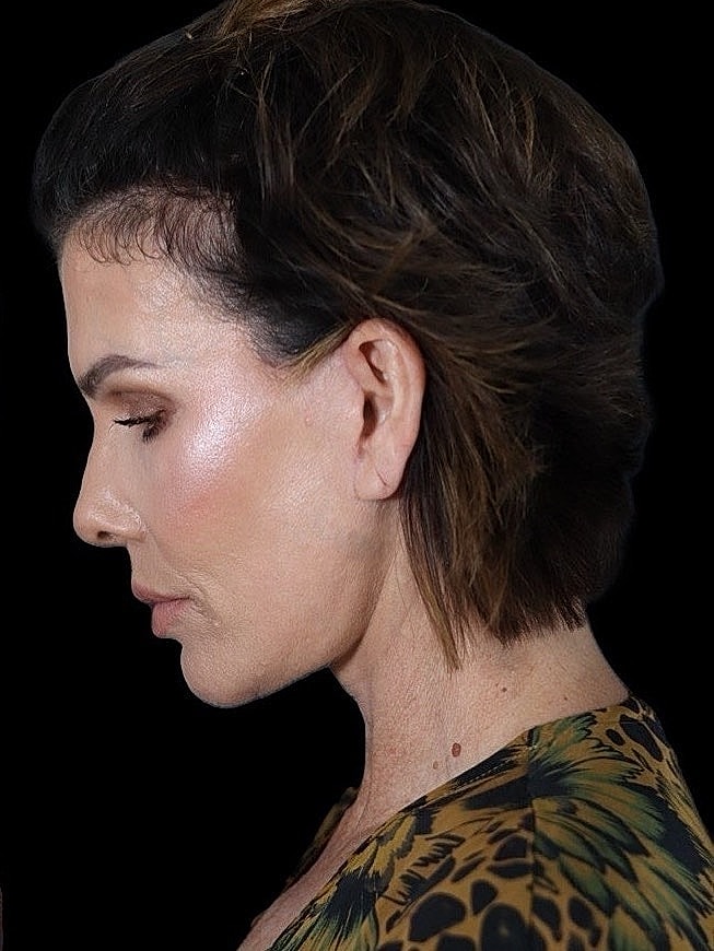 Deep Plane Facelift Gallery Before & After