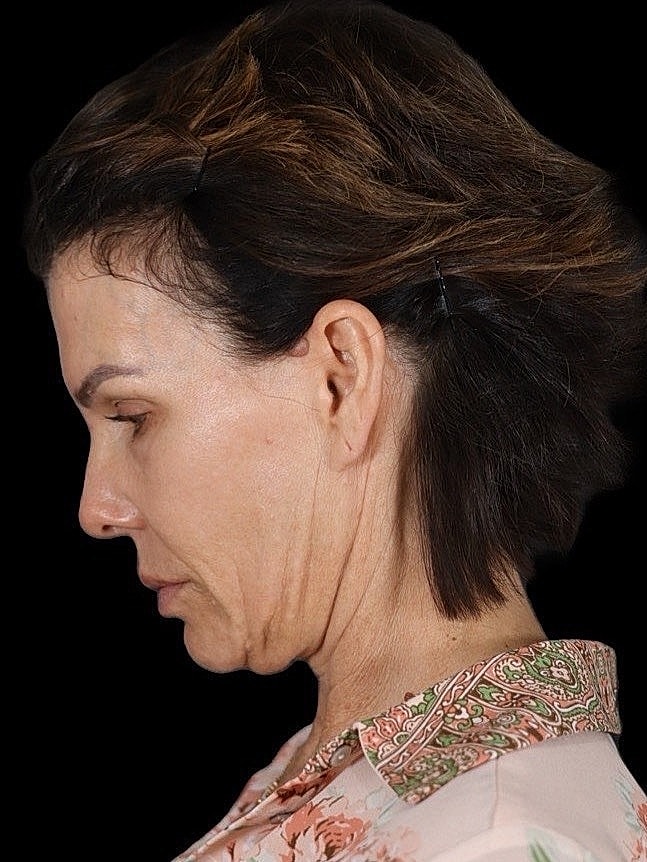 Deep Plane Facelift Gallery Before & After