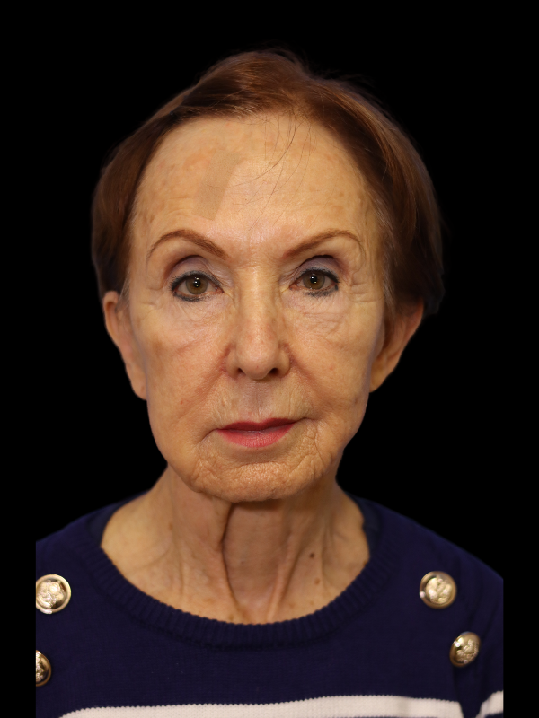 Deep Plane Facelift Gallery Before & After