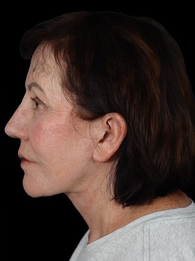 Deep Plane Facelift Gallery Before & After