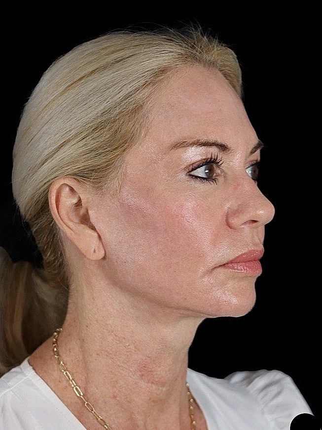 Deep Plane Facelift Gallery Before & After