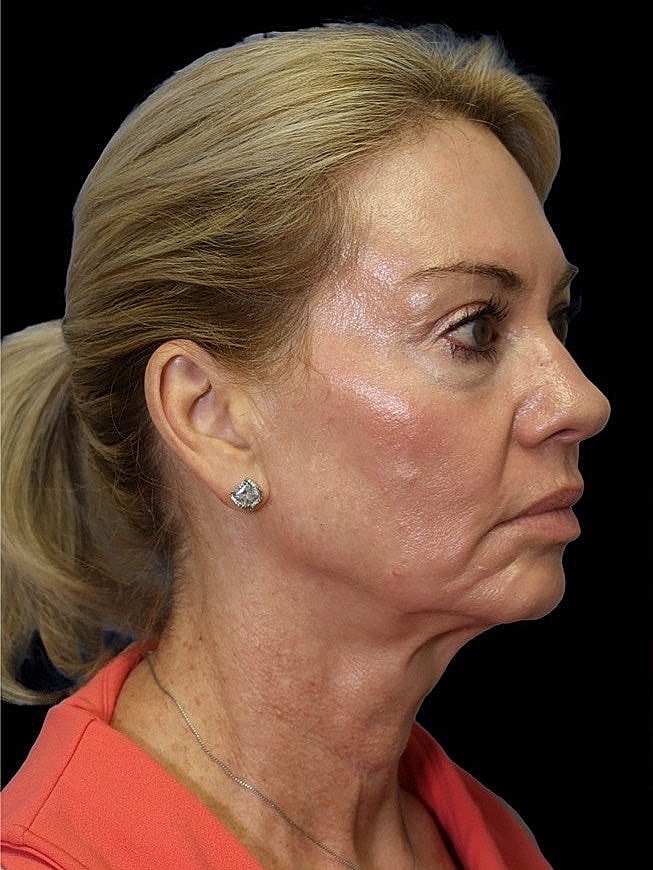 Deep Plane Facelift Gallery Before & After