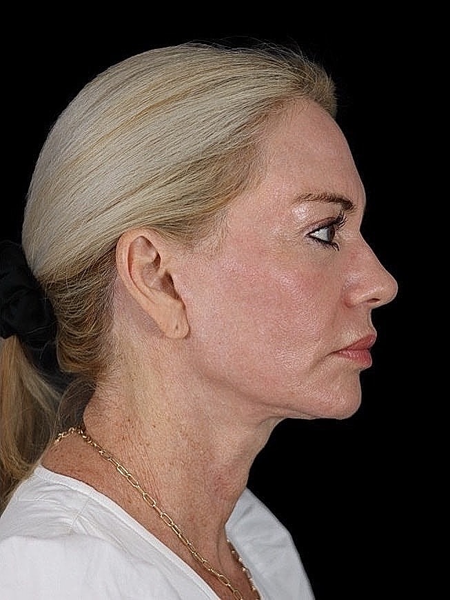 Deep Plane Facelift Gallery Before & After