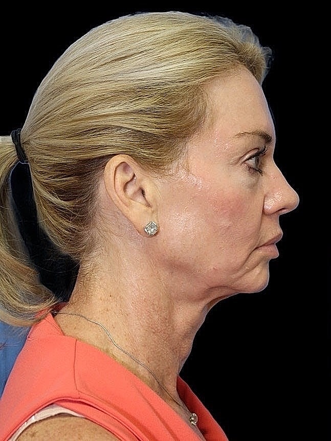 Deep Plane Facelift Gallery Before & After