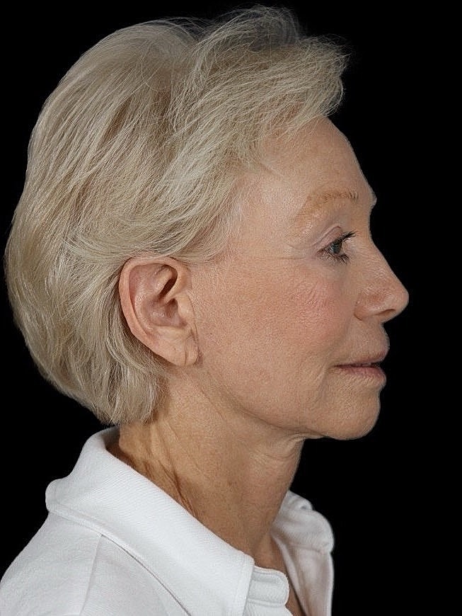 Deep Plane Facelift Gallery Before & After
