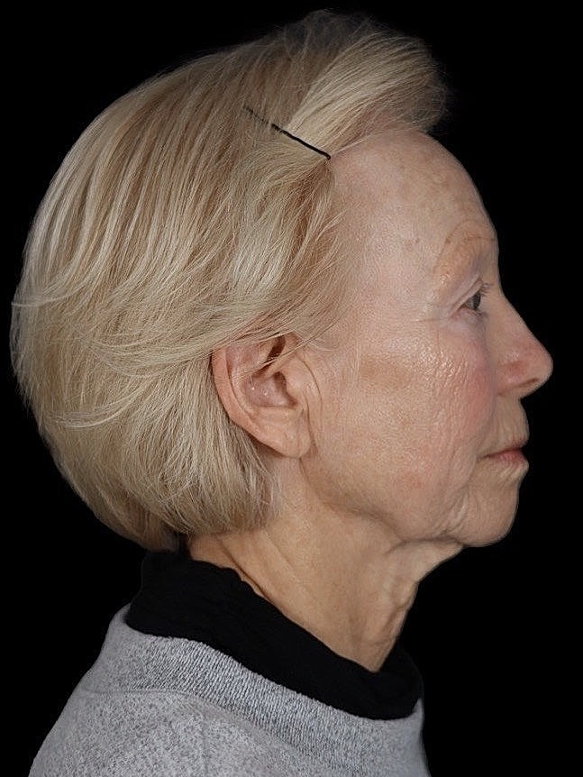 Deep Plane Facelift Gallery Before & After