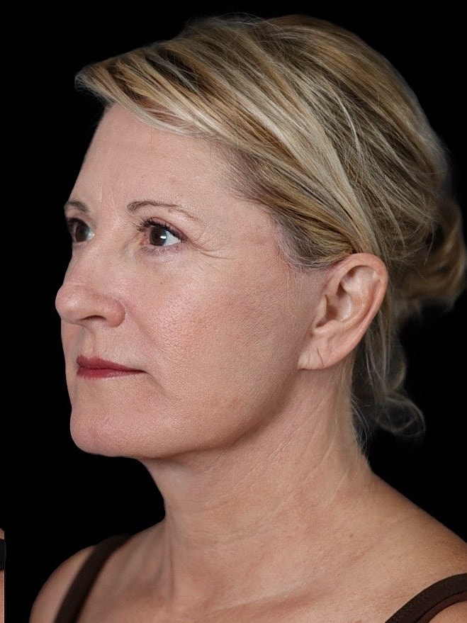 Deep Plane Facelift Gallery Before & After