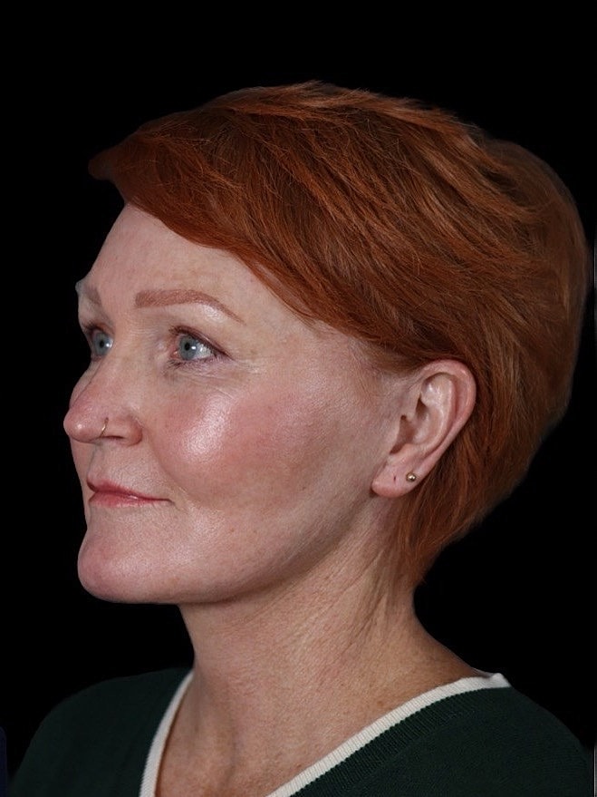 Deep Plane Facelift Gallery Before & After