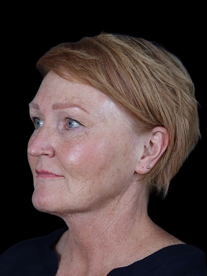 Deep Plane Facelift Gallery Before & After