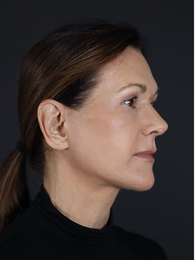 Deep Plane Facelift Gallery Before & After