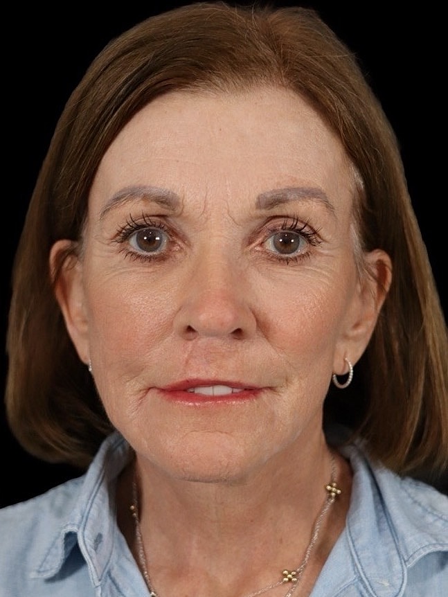 Deep Plane Facelift Gallery Before & After