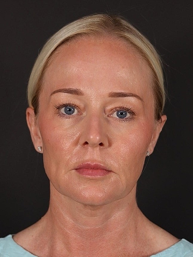 Deep Plane Facelift Gallery Before & After