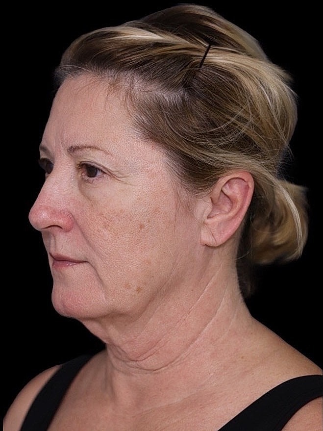 Deep Plane Facelift Gallery Before & After