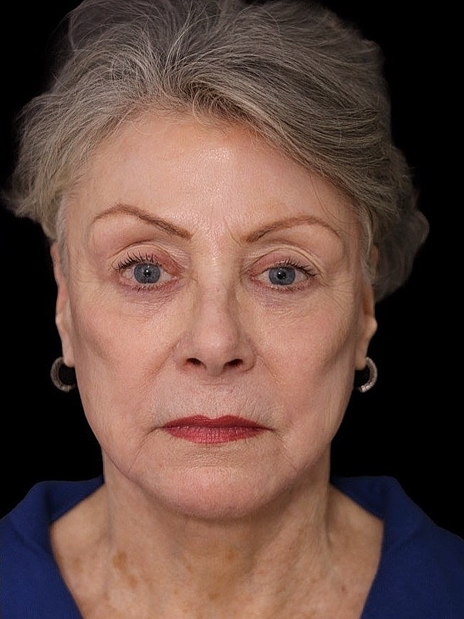 Deep Plane Facelift Gallery Before & After