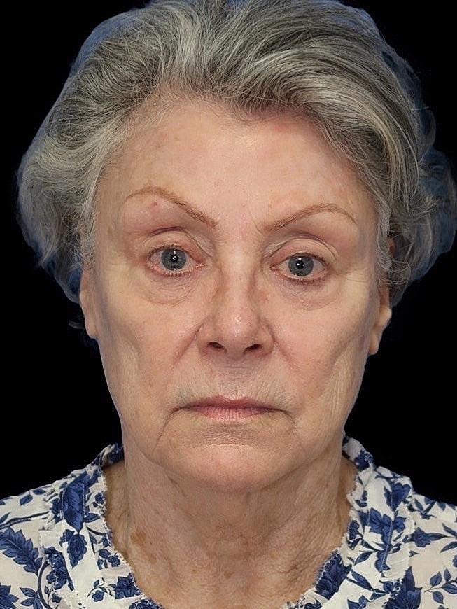 Deep Plane Facelift Gallery Before & After