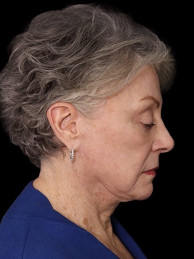 Deep Plane Facelift Gallery Before & After