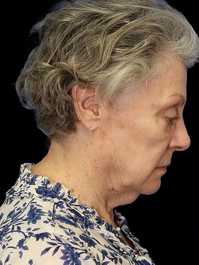 Deep Plane Facelift Gallery Before & After