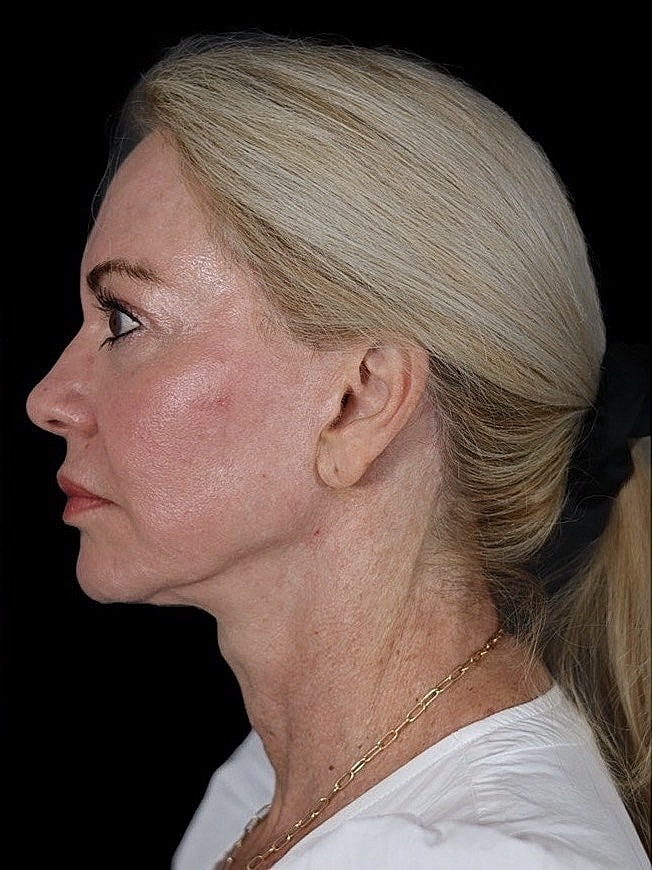 Deep Plane Facelift Gallery Before & After