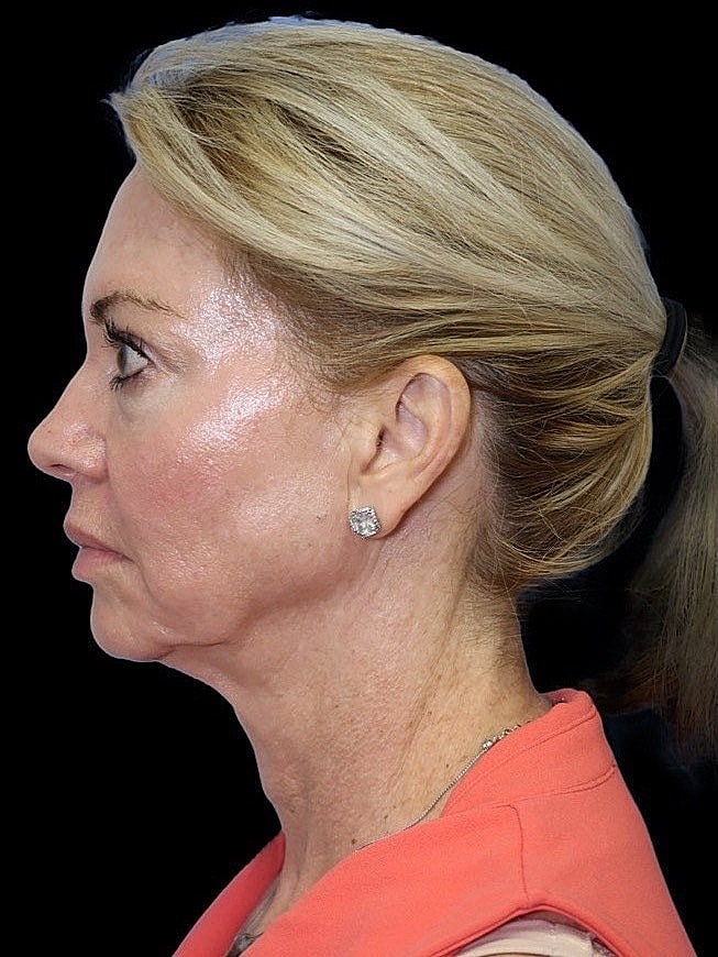 Deep Plane Facelift Gallery Before & After