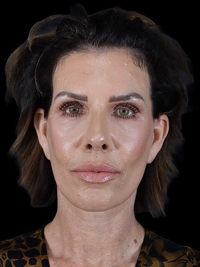 Deep Plane Facelift Gallery Before & After