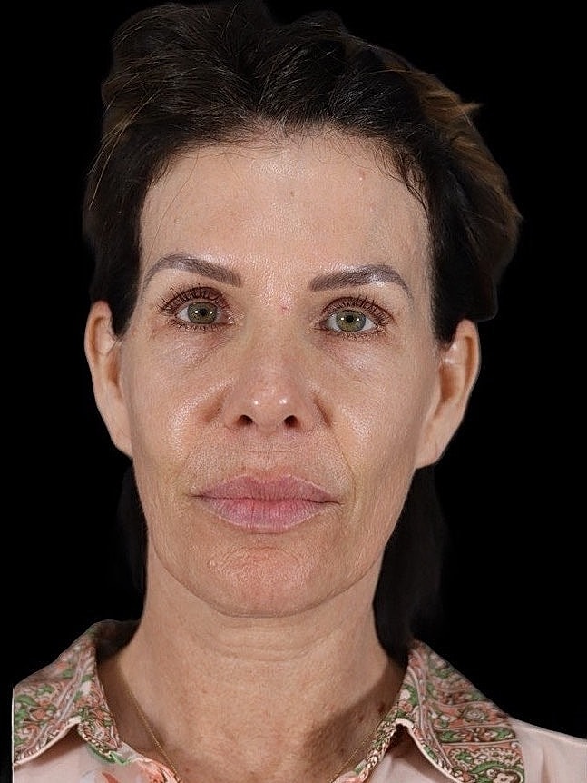Deep Plane Facelift Gallery Before & After