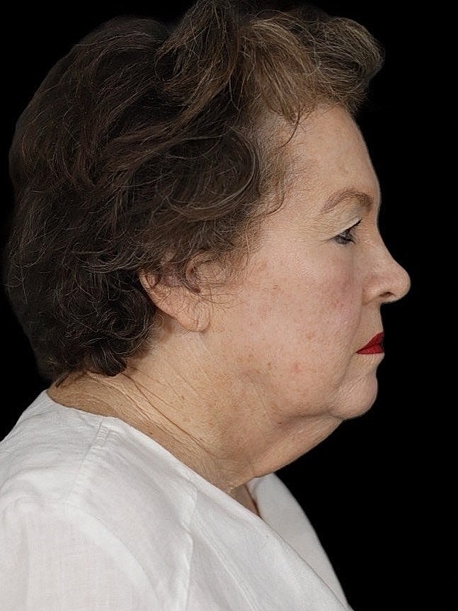 Deep Plane Facelift Gallery Before & After