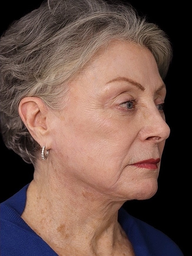 Deep Plane Facelift Gallery Before & After