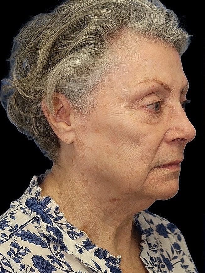 Deep Plane Facelift Gallery Before & After
