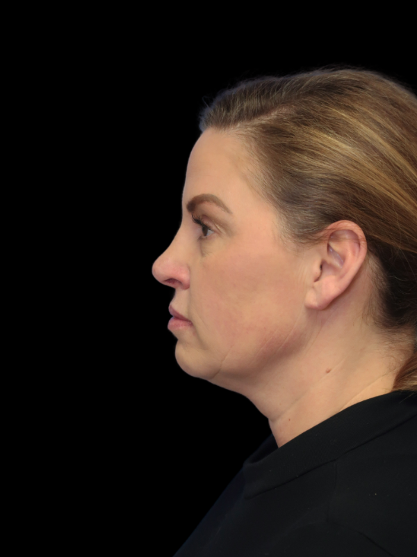 Deep Plane Facelift Gallery Before & After