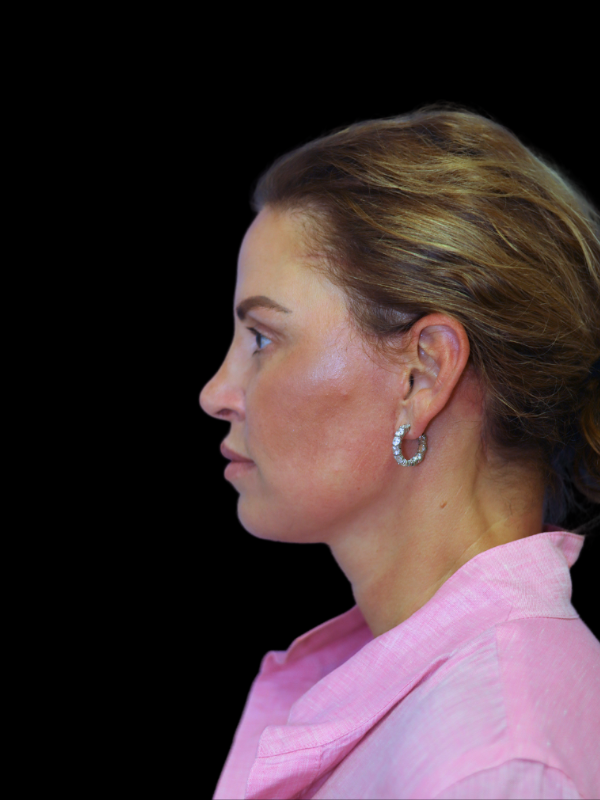 Deep Plane Facelift Gallery Before & After