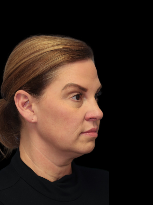 Deep Plane Facelift Gallery Before & After