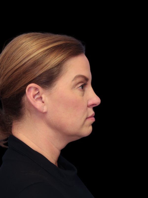 Deep Plane Facelift Gallery Before & After