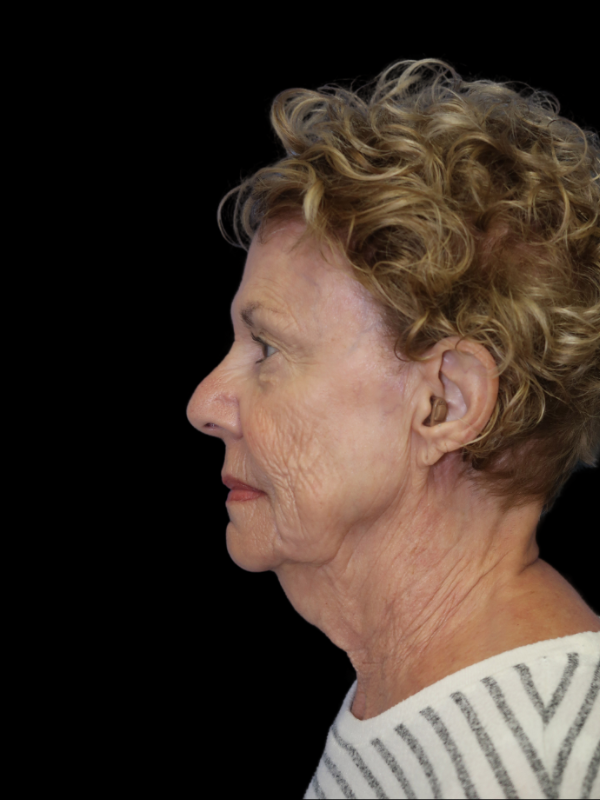 Deep Plane Facelift Gallery Before & After