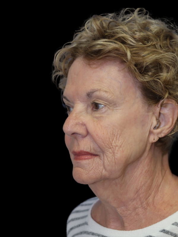 Deep Plane Facelift Gallery Before & After