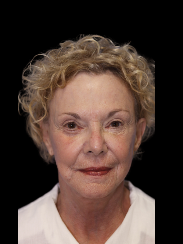 Deep Plane Facelift Gallery Before & After