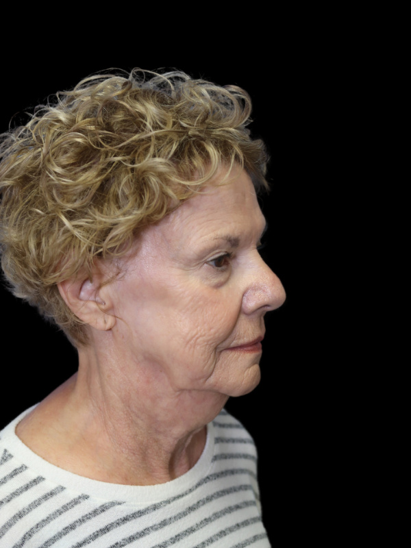 Deep Plane Facelift Gallery Before & After