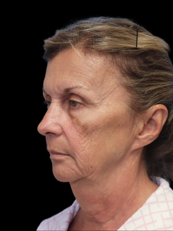 Deep Plane Facelift Gallery Before & After