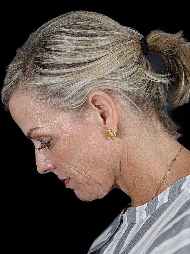 Deep Plane Facelift Gallery Before & After