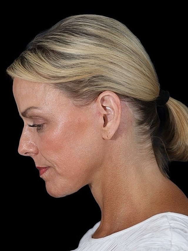 Deep Plane Facelift Gallery Before & After