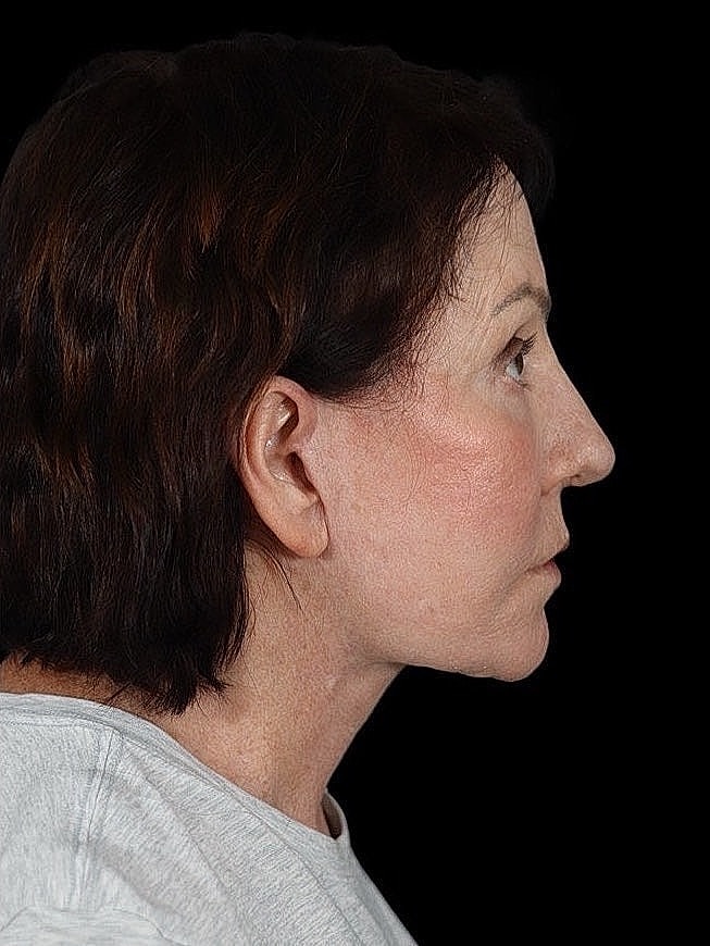 Deep Plane Facelift Gallery Before & After