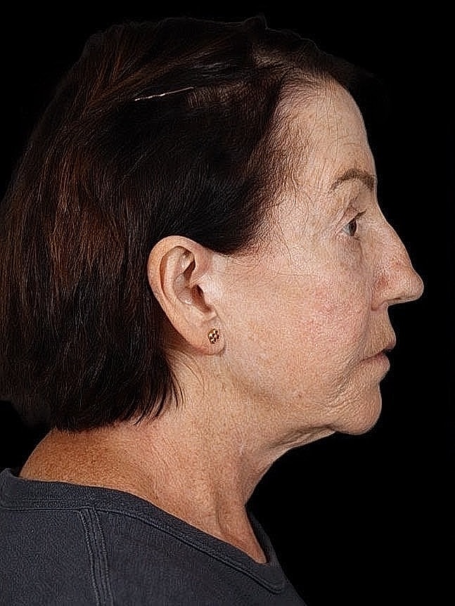 Deep Plane Facelift Gallery Before & After