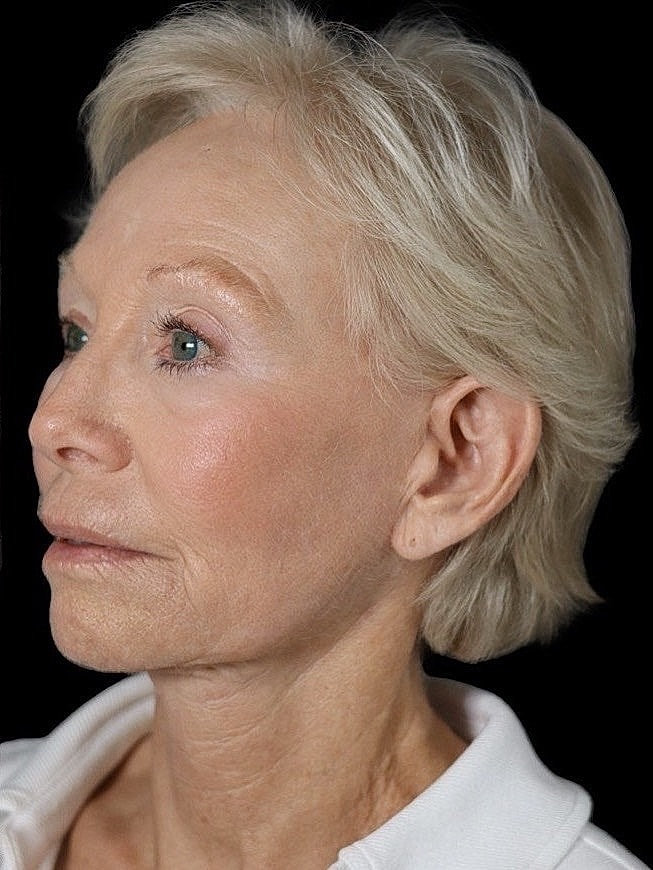 Deep Plane Facelift Gallery Before & After