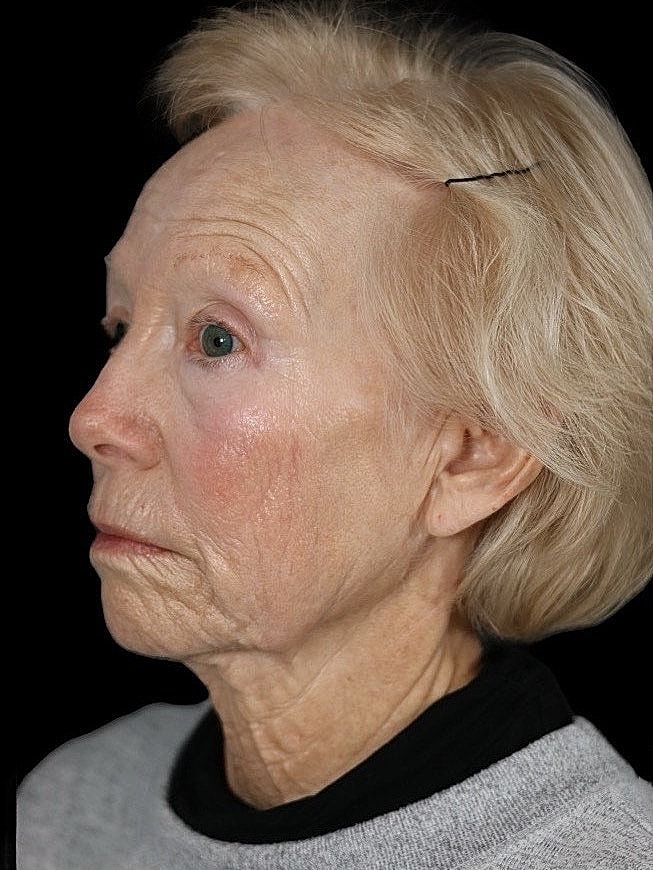 Deep Plane Facelift Gallery Before & After