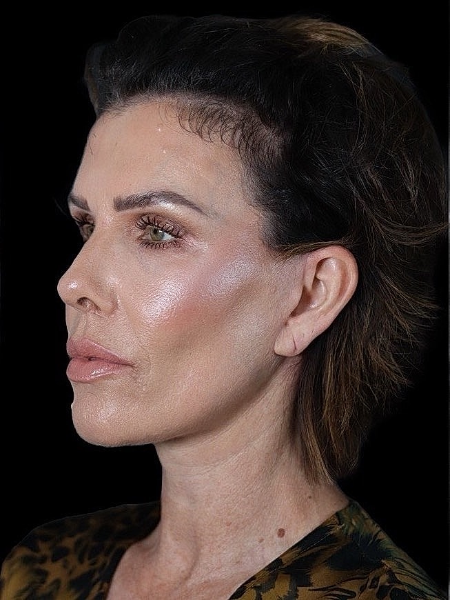 Deep Plane Facelift Gallery Before & After
