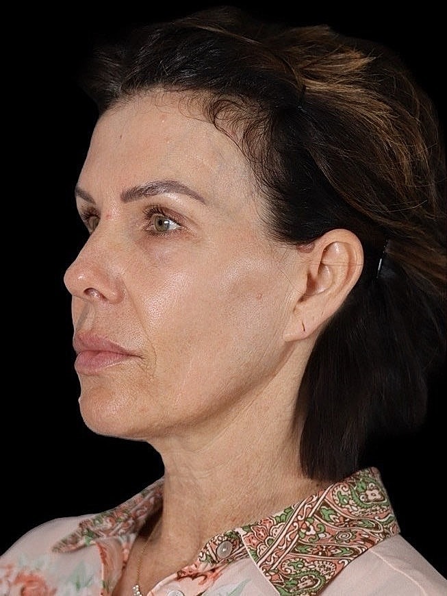 Deep Plane Facelift Gallery Before & After