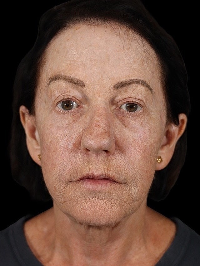 Deep Plane Facelift Gallery Before & After