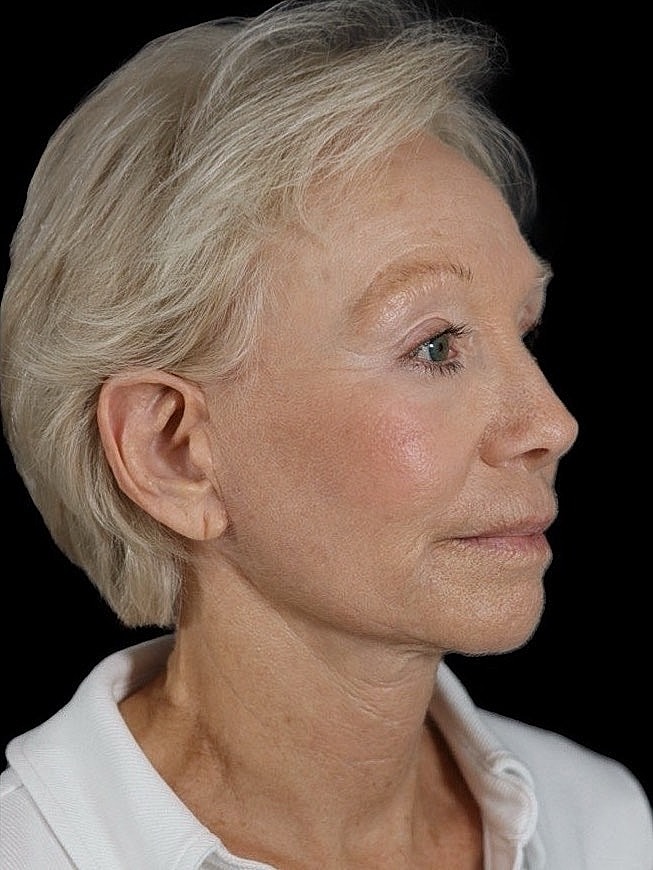 Deep Plane Facelift Gallery Before & After