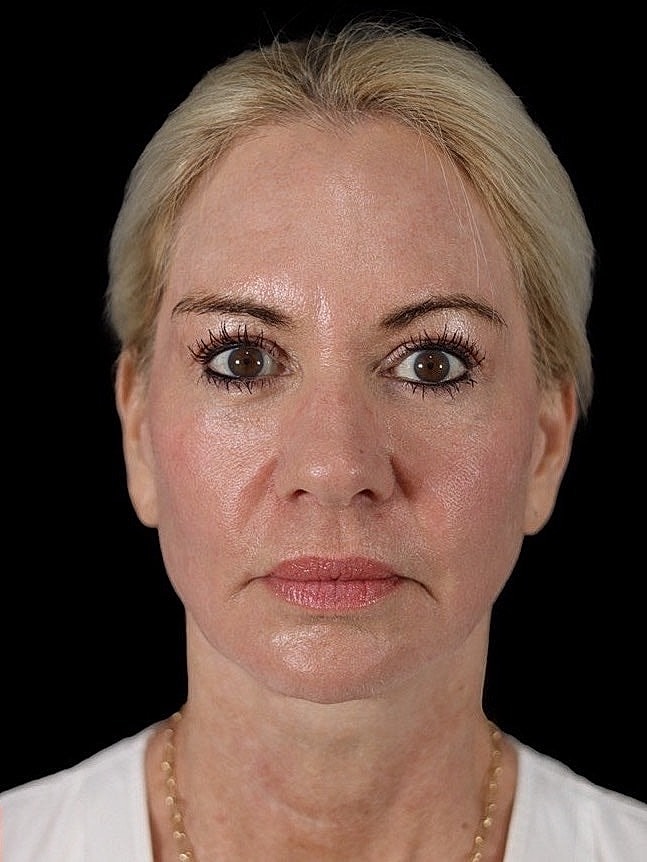 Deep Plane Facelift Gallery Before & After